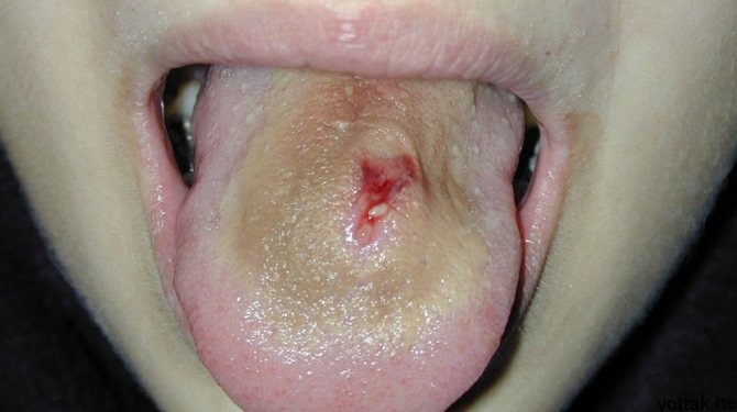 Tongue ailments can cause sore spots to not heal properly