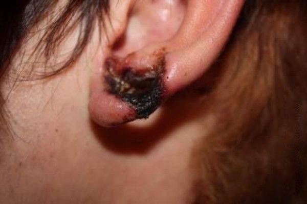 fáj, ha alagutakat csinálnak a fülekben?