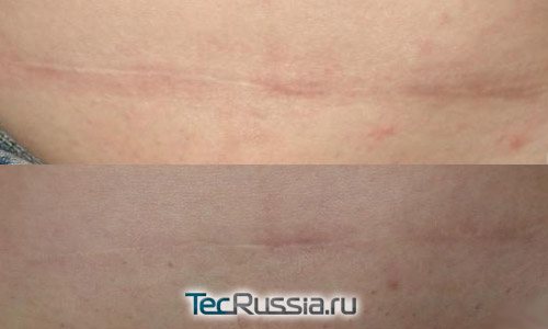 Antes e depois da utilização de Contraktubex numa cicatriz de cesarianas
