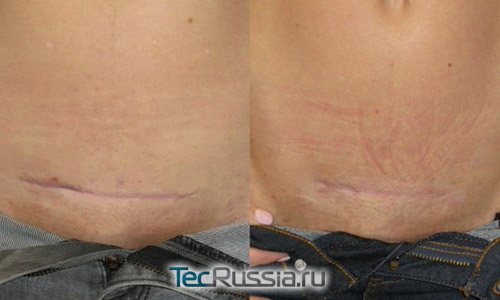 Prima e dopo la correzione laser di una cicatrice addominale orizzontale