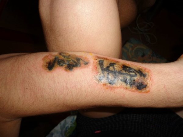 Ako odstrániť tetovanie, odstránenie tetovania doma