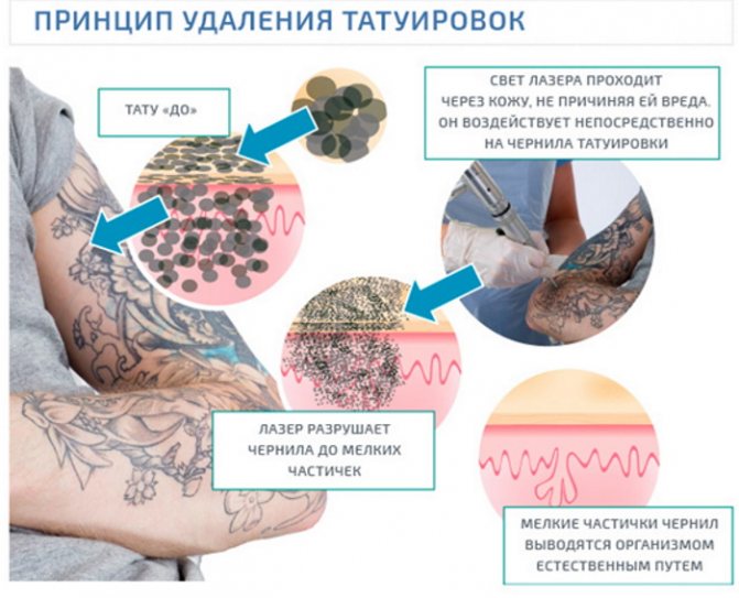 Kako se znebiti tetovaže, odstranjevanje tetovaže doma