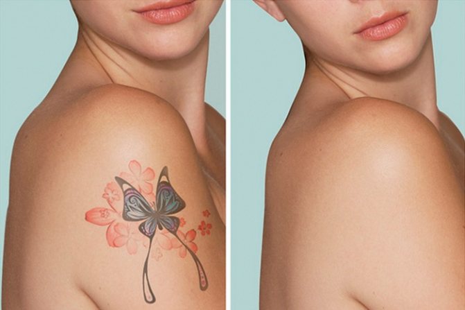 Cum să eliminați tatuajele cu un laser