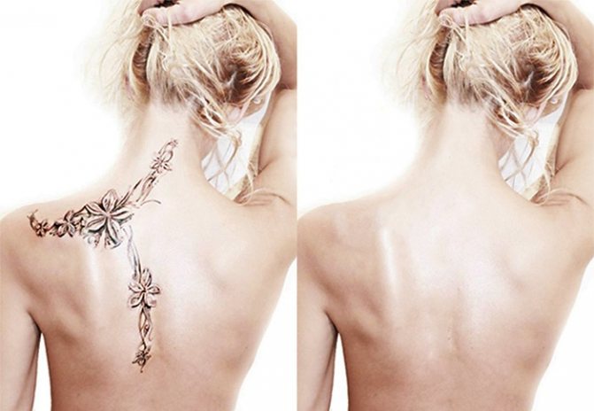 Hogyan lehet eltávolítani a tetoválásokat lézerrel