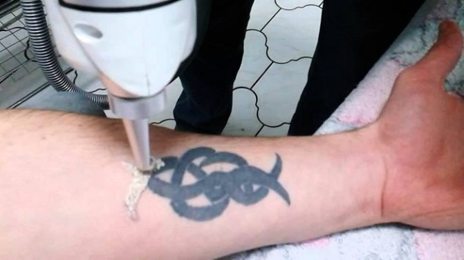 Как да премахнете татуировка без белег