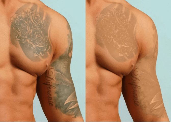 Aký druh odstránenia tetovania je jednoduchšie odstrániť?
