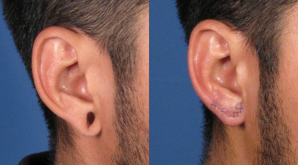 Quem tem túneis nos seus ouvidos e como?