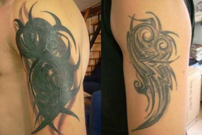 Tetoválás korrekció