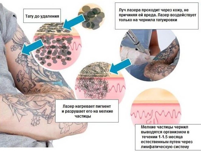 Remoção de tatuagens a laser. Revisões, antes e depois das fotos