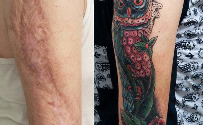 Posso fazer uma tatuagem nas minhas cicatrizes? Que tipo de tatuagens posso encobrir? Responder a perguntas