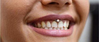 Piercing sotto il labbro superiore (sorriso) sul frenulo. Foto, conseguenze, recensioni