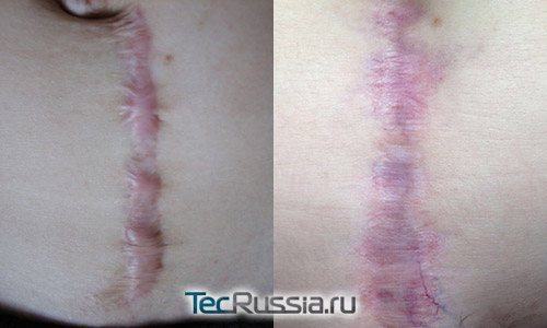 Risultati del resurfacing laser della cicatrice verticale dopo il parto cesareo