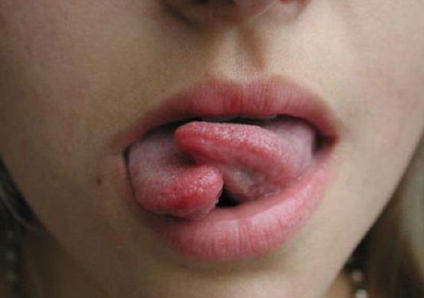 Liežuvio skilimo pasekmės