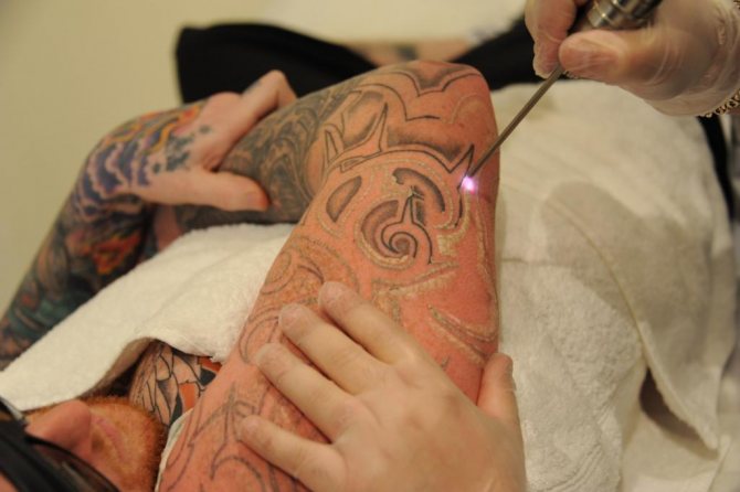 Лазерно отстраняване на татуировки преди и след