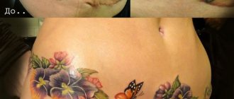 Tetovanie na zakrytie stehov na bruchu po cisárskom reze