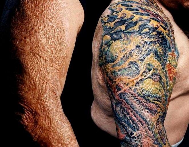Τατουάζ σε εγκαύματα