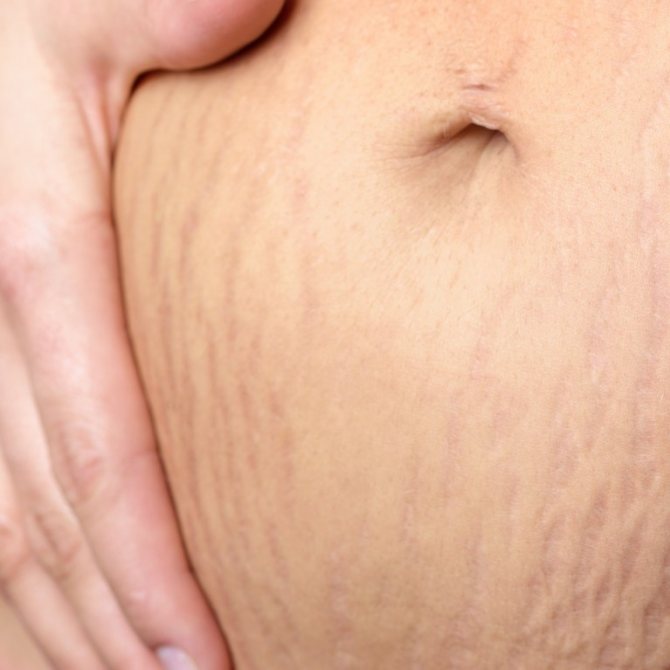Tetoválás a hason a szülés után a terhességi csíkokon