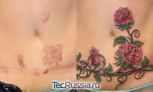 Il tatuaggio sulla pancia nasconde la cicatrice dopo l'operazione