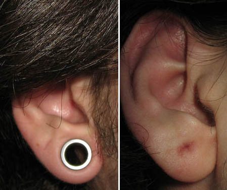 女孩耳朵里的隧道。照片，妊娠纹的大小，护理。