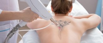 Laser de remoção de tatuagens