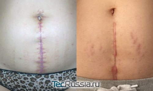 Cicatrizarea verticală după operația cezariană