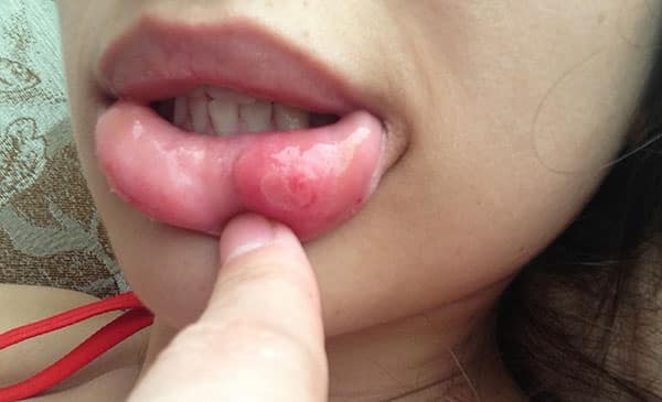 Възпаление на пиърсинга на устните