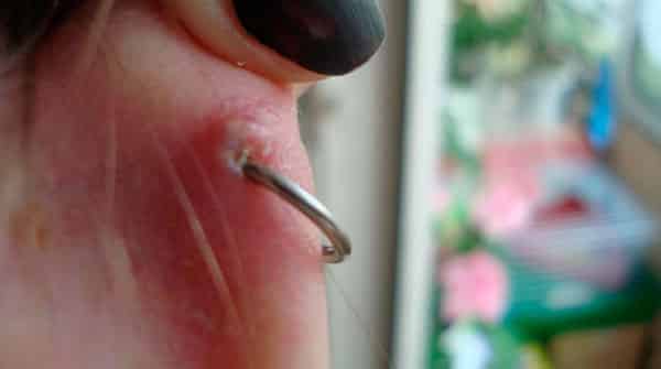 Infiammazione dei piercing all'orecchio
