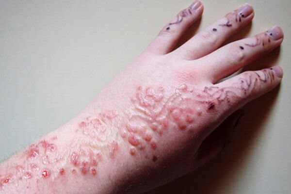 Possibili complicazioni del tatuaggio all'henné