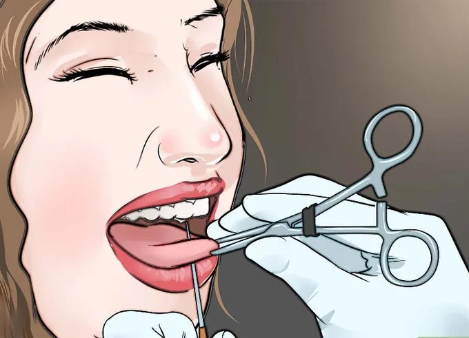 关于舌头穿孔的一切：穿孔、护理、可能的后果