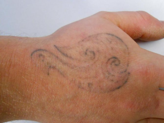 Odstránenie tetovania na ruke