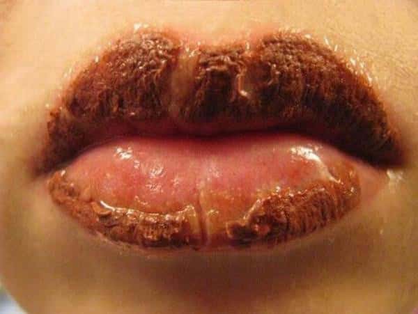 Lippen genezen